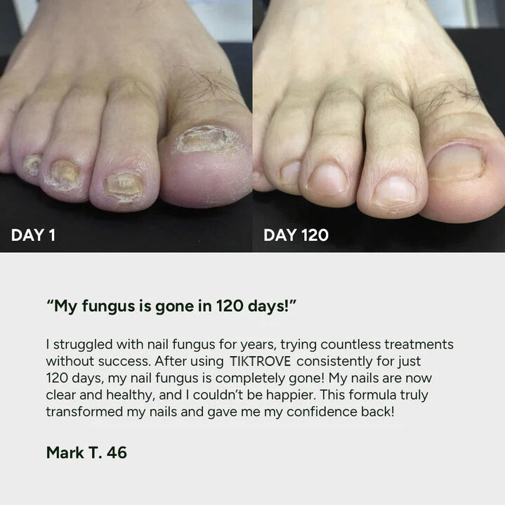 Nail Fungus Treatment Gel