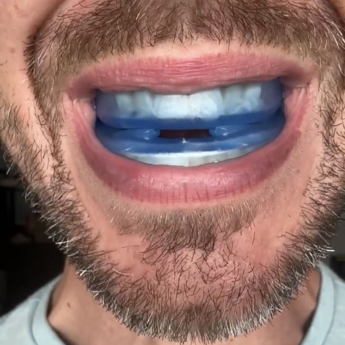 Tiktrove Anti-Snoring Mouthpiece Universal Size
